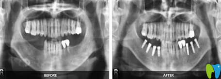 福州貝臣齒科種植牙案例
