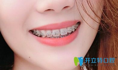 黃飛做牙齒矯正第118天效果圖一覽