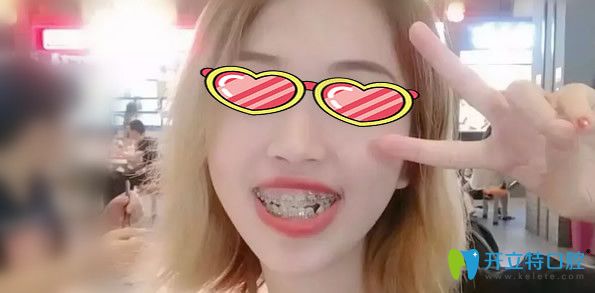 戴牙套矯正牙齒6個(gè)月恢復(fù)效果