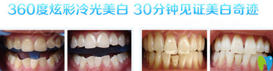 福州哪家牙科好？看貝臣齒科冷光美白案例來(lái)證明