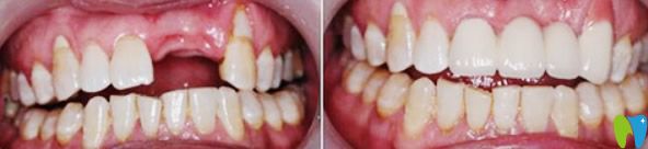 <!--<i data=20240703-sp></i>-->口腔門(mén)牙缺失種植修復(fù)案例