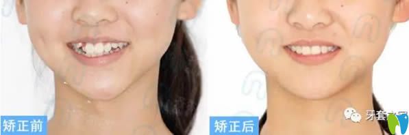 李詩(shī)佩青少年安氏I類(lèi)錯(cuò)合固定矯正案例