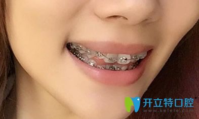 找黃飛做牙齒矯正后戴牙套第3天照片