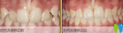 隋冬梅深覆頜采用時(shí)代采用時(shí)代天使隱形矯正案例對(duì)比圖