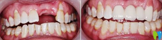 <!--<i data=20240703-sp></i>-->億大口腔蘇濤醫(yī)生牙齒種植案例