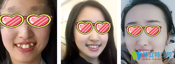 <!--<i data=20240703-sp></i>-->億大口腔傳統(tǒng)金屬托槽矯正牙齒效果對比圖