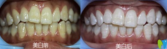 天津美萊口腔靠譜嗎？來看顧客冷光美白治療前后效果對比