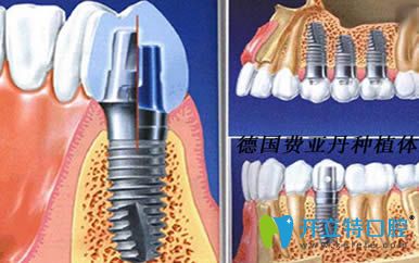 列舉德國(guó)種植牙品牌有哪些以及費(fèi)亞丹/icx/bego種植系統(tǒng)簡(jiǎn)介