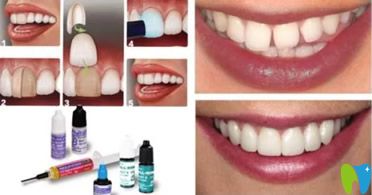 樹脂貼面相對來說價(jià)格稍低