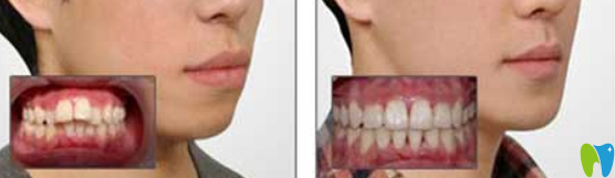 天津美萊口腔牙齒矯正怎么樣？真人案例效果及反饋來驗(yàn)證