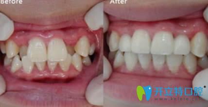 呼和浩特紅十字口腔隱適美隱形牙齒矯正前后效果對(duì)比圖