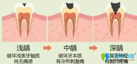 補(bǔ)牙的價(jià)格和牙齒齲壞的程度有關(guān)