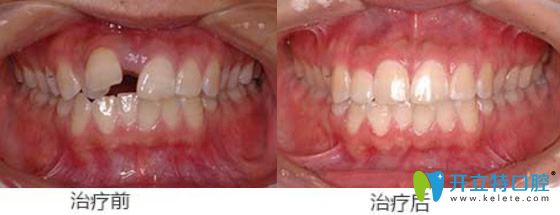 屬于天津美萊口腔的牙齒錯位、牙間縫矯正案例
