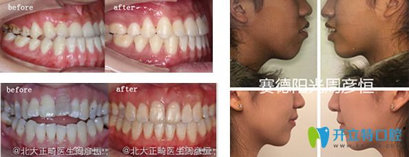 骨性齙牙正畸案例+牙齒咬合不齊矯正前后效果對比圖