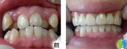 壹加壹口腔矯正牙齒前后療效對比