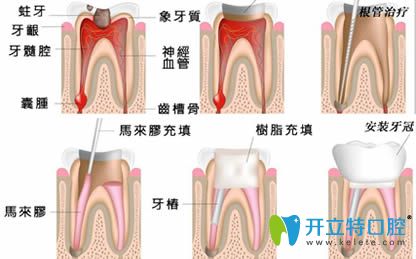 開立特根管治療牙神經(jīng)痛