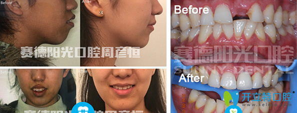 <!--<i data=20240703-sp></i>-->口腔正畸+種植牙效果案例