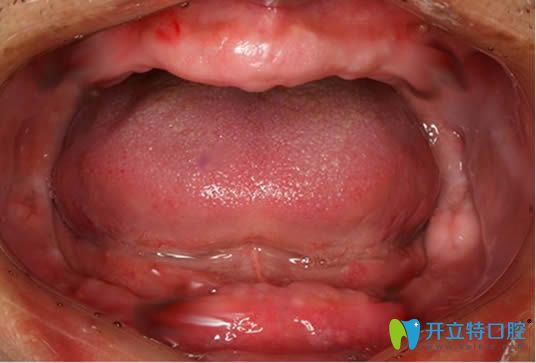 我?guī)Я?0年的活動假牙，沒做種植牙卻讓活動假牙害我一生啊