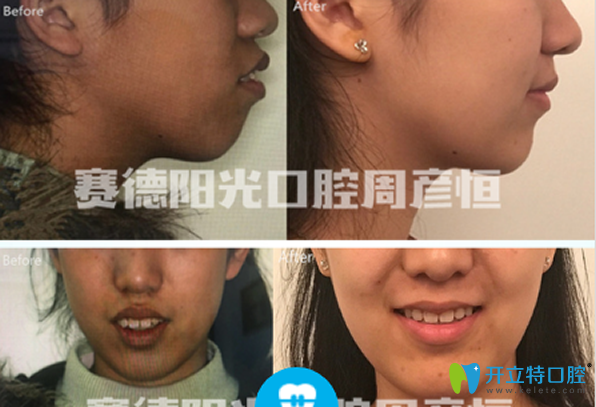 <!--<i data=20240703-sp></i>-->口腔骨性齙牙矯正前后效果對比