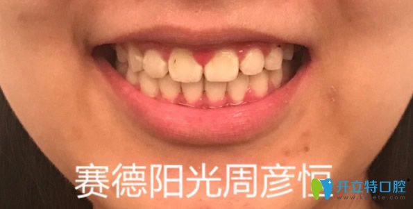 深圳賽德陽關口腔金屬托槽矯正牙齒效果怎么樣