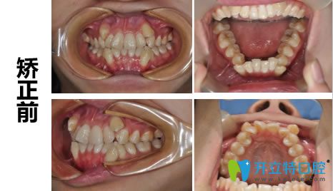 長沙愛思特彭斌隱適美矯正案例 看30歲顧客矯正效果怎么樣