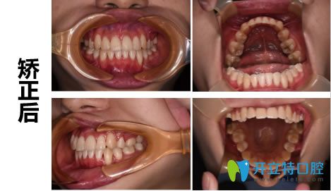 戴隱形牙套19個月后的正畸效果
