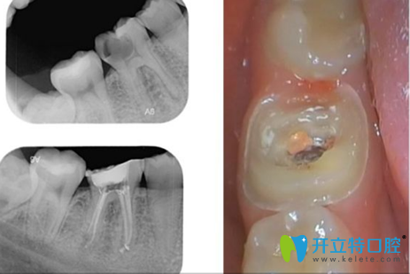 歡樂口腔華貿(mào)分院根管治療+烤瓷牙冠+補牙+洗牙綜合治療案例