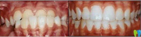 長沙愛思特口腔彭斌醫(yī)生地包天矯正案例