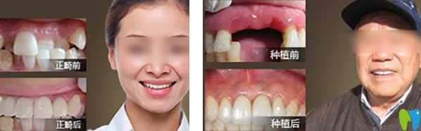 德韓口腔<!--<i data=20240703-sp></i>-->國種植牙及正畸效果案例