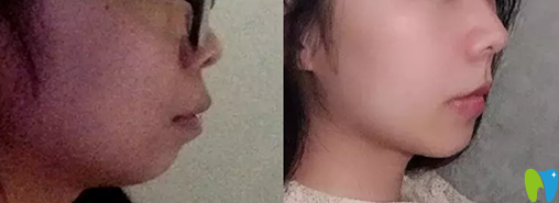 用我在長沙科爾雅臉型變化圖來驗證骨性齙牙矯正有效果嗎