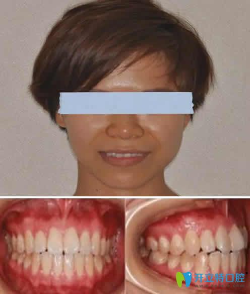 牙齒矯正可以做半口嗎 附我在蘭州惠安齒科做隱形矯正照片