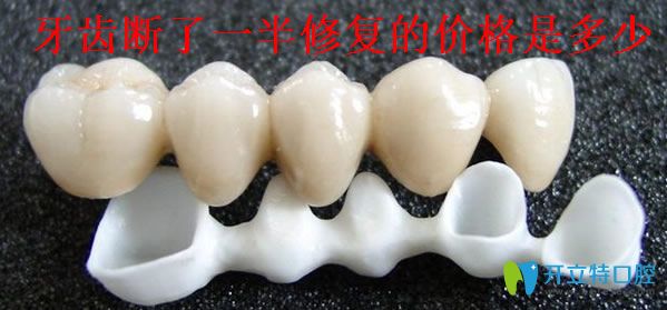 牙齒斷了一半修復(fù)的價(jià)格是多少