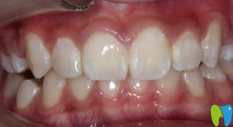 大連昭鶴口腔門診牙齒正畸后效果圖 大連昭鶴口腔門診牙齒正畸后效果圖