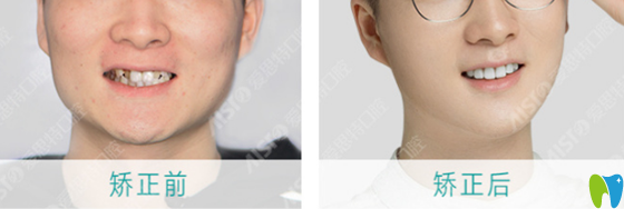 珠海愛思特怎么樣呢？來看顧客真人牙齒矯正案例