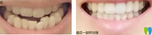 武漢德韓口腔矯牙前后效果對(duì)比
