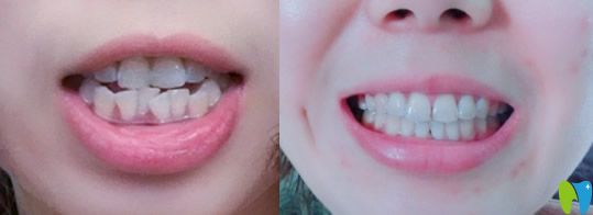 愛思特口腔牙齒過度擁擠不齊矯正案例