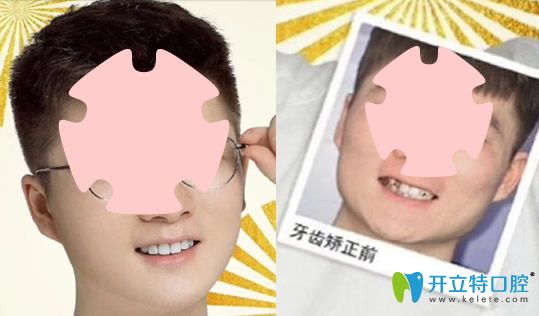 去珠海愛思特口腔做牙齒不齊、個別反頜矯正案例對比圖