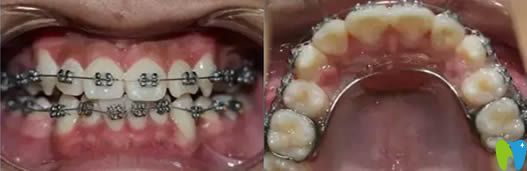 兒子在大連昭鶴口腔戴金屬托槽牙套的圖片 兒子在大連昭鶴口腔戴金屬托槽牙套的圖片