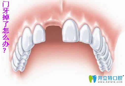 想知道20多歲門牙掉了怎么辦？能做種植牙嗎