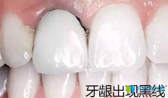 全瓷牙不會(huì)讓牙齦變黑