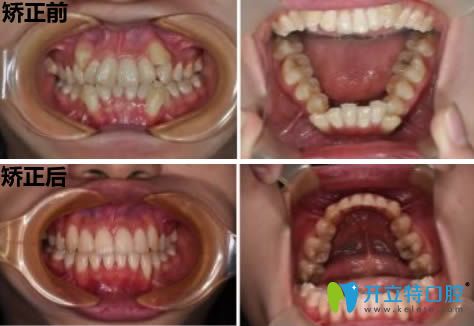 28歲的小張矯正牙齒前后對比照片