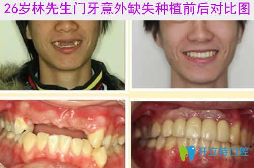 門(mén)牙意外缺失種植前后對(duì)比圖