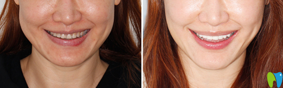 珠海愛思特口腔3D超薄瓷貼面修復案例效果對比