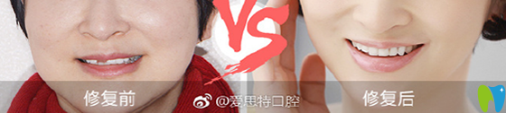 在愛思特口腔進行進口全瓷牙美學修復案例前后效果對比圖