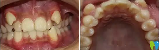 說(shuō)說(shuō)13歲的兒子在大連昭鶴口腔做牙齒正畸的效果和經(jīng)歷