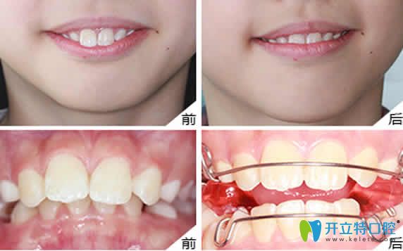 無錫金貝齊齒科牙齒矯正效果圖 無錫金貝齊齒科牙齒矯正效果圖