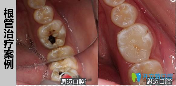 成都思邁口腔陳德昊醫(yī)生根管治療案例