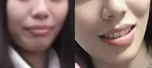 今天下牙套啦，我在東莞好佰年口腔矯正齙牙歷時(shí)1045天