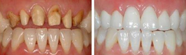 牙齒缺損掉落什么原因 成都皓雅口腔揭曉牙齒缺損修復方法