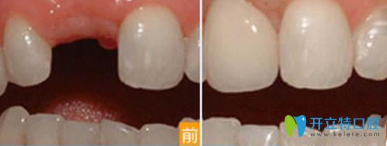 寧波壹加壹口腔茅來發(fā)主任單顆種植牙效果圖